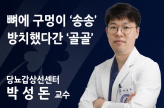 뼈에 구멍이 ‘송송’ 방치했다간 ‘골골’… 나도 모르게 찾아오는 ‘골다공증’